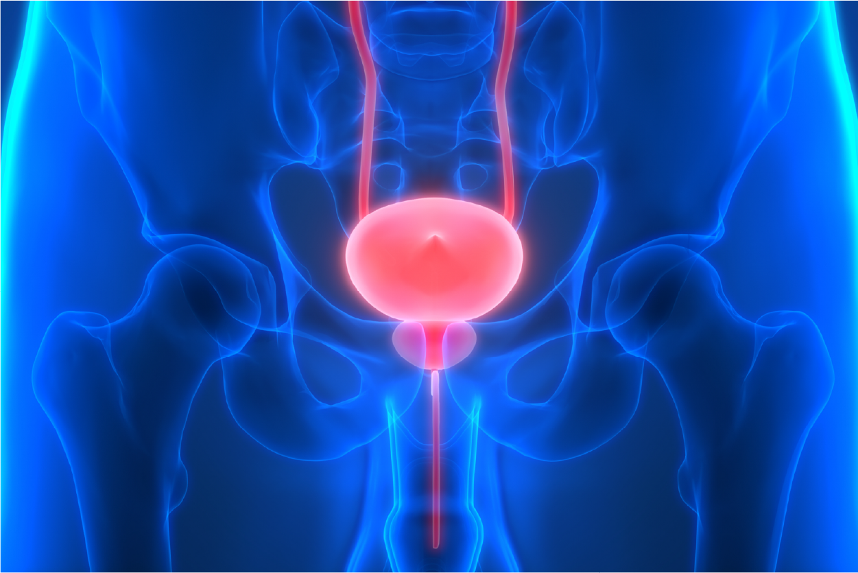 Bladder Cancer
