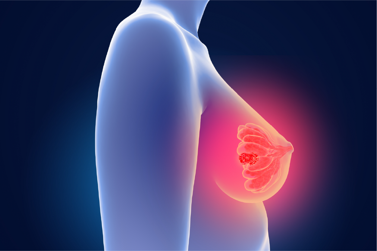 Breast Cancer