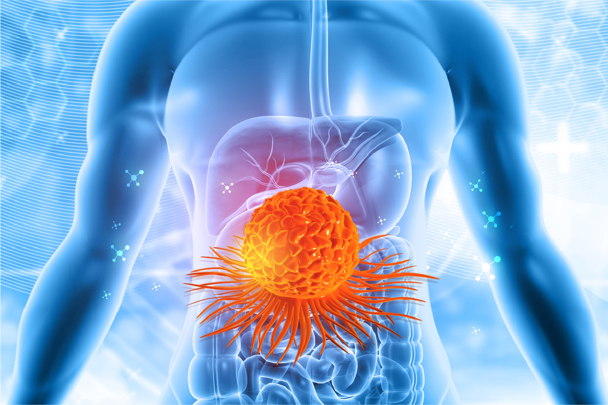 Cancer of Unknown Primary Origin