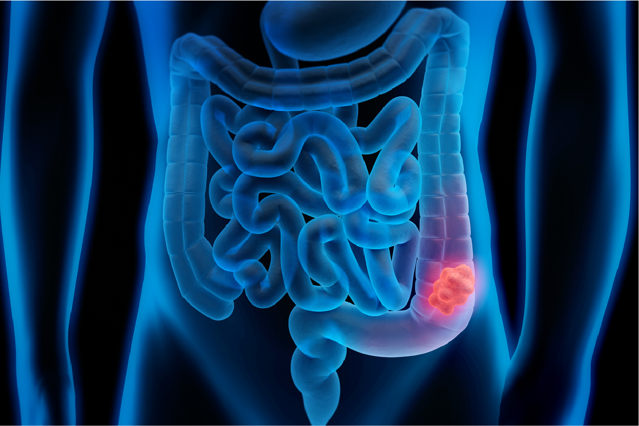 Colorectal Cancer