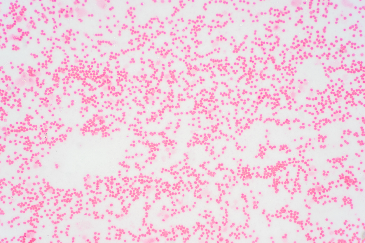 Myelodysplastic Syndromes